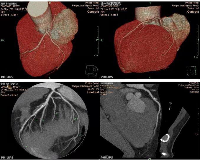 【院内时讯】锦州市妇婴医院放射线科顺利完成院内首例冠状动脉CTA检查