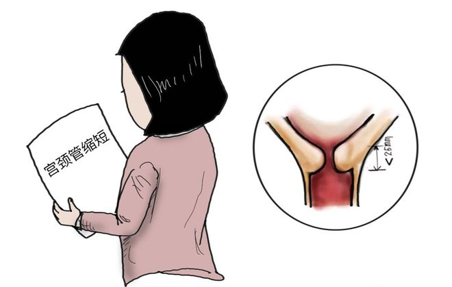 【优势技术】宫颈环扎术