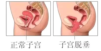【健康科普】产后盆底康复，你做了吗?