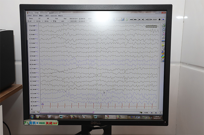 儿童视频脑电图监测