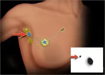 【优势技术】超声引导下腋窝淋巴结穿刺