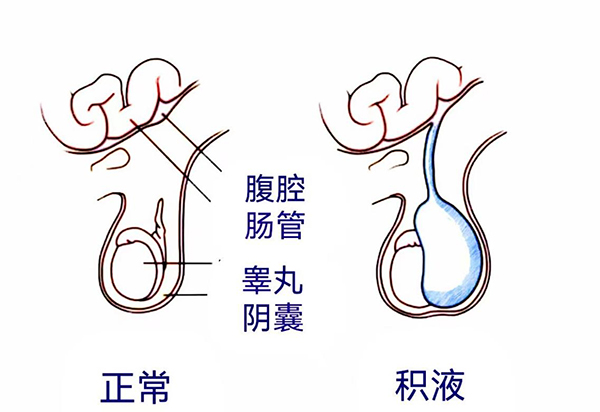 【健康科普】宝宝的蛋蛋一大一小？是蛋蛋进水了么？
