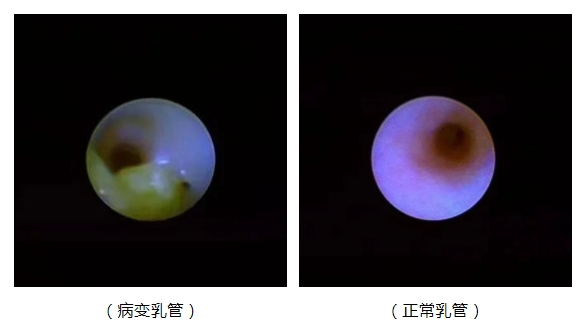 【健康科普】说说乳头溢液与乳管镜