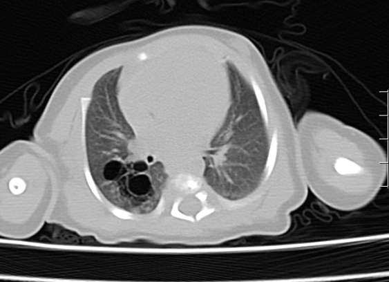 【健康科普】探秘先天性肺气道畸形