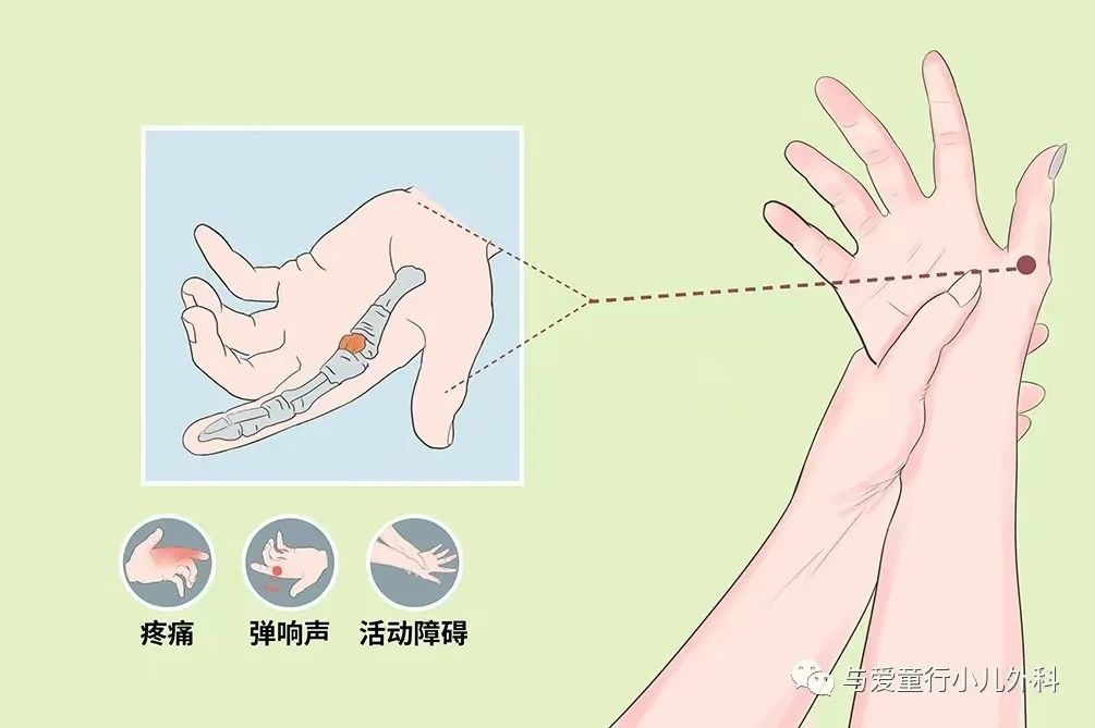 健康科普】警惕儿童拇指狭窄性腱鞘炎