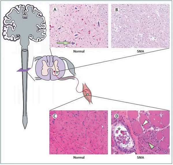 【优势技术】锦州市妇婴医院（妇幼保健院）可以做SMA基因检测了