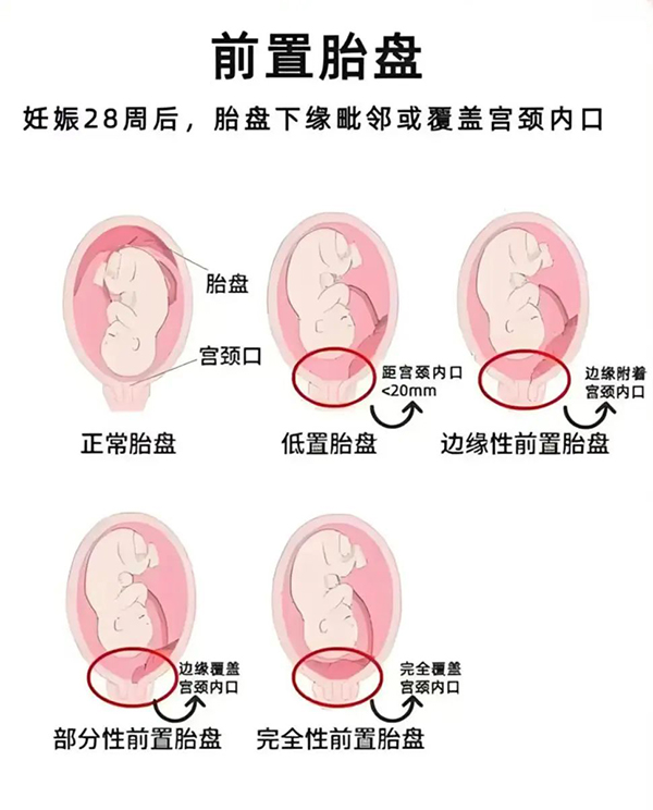 【优势专科】完全性前置胎盘产妇的“生命保卫战”