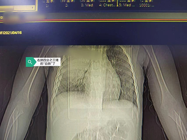 【健康科普】被“啃”的肺子