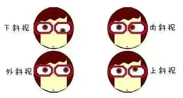 【健康科普】真假斜视，一招自测，早发现早干预