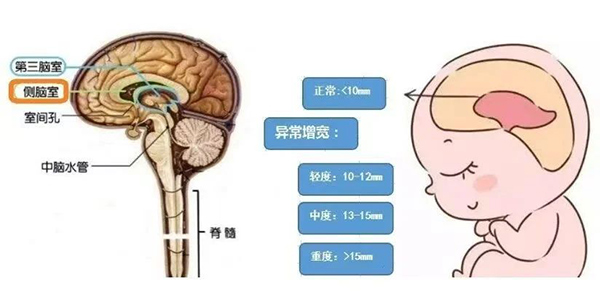 【健康科普】胎儿侧脑室增宽，科学应对不焦虑