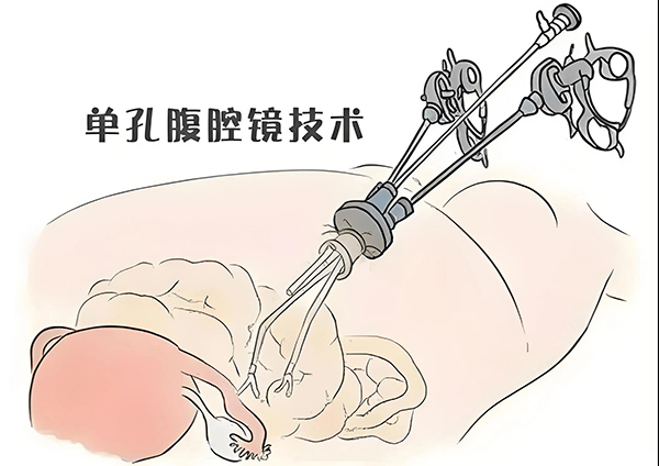 【优势技术】巨大囊肿不用愁，单孔手术解您忧！