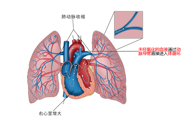 【优势专科】从危急入院到治愈出院，早产宝宝的“肺动脉高压”之战