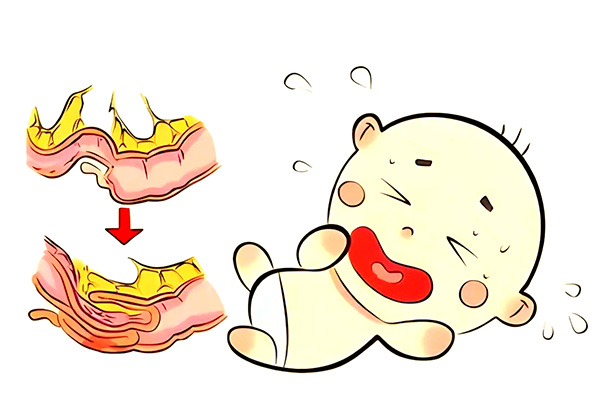【健康科普】警惕高发病急腹症：儿童肠套叠，别被急性肠炎掩盖风险！
