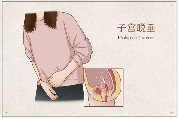 【健康科普】37岁妈妈遭遇子宫脱垂，这项微创技术让她“保宫”重获轻盈人生