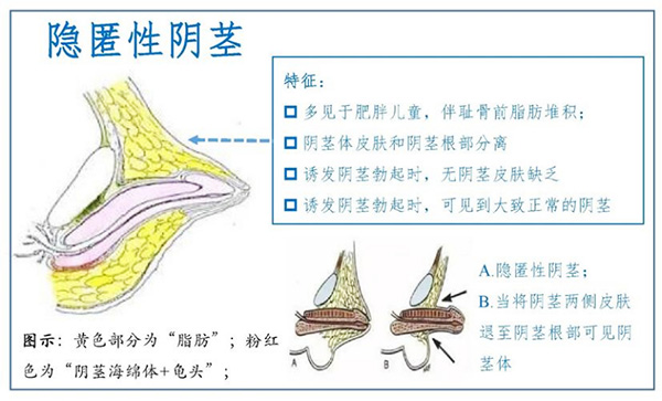 【健康科普】揭开儿童“小鸡鸡”的神秘面纱